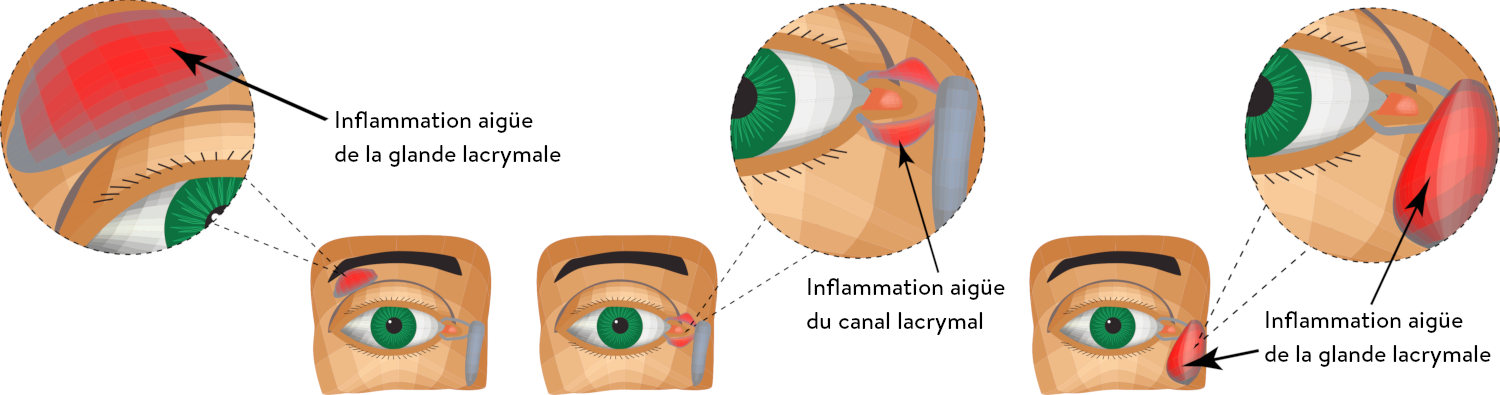 Chirurgie des voies lacrimales